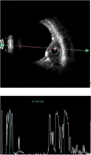rectus muscle cystecercosis 
rectus muscle cyst with internally two high reflective spot that is scolex ,,,with globe indentation by the cyst
Keywords: cystecercosis