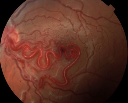 wyburn-mason sydrome
28 year old female, visual acuity OS 20/200
Keywords: wyburn mason