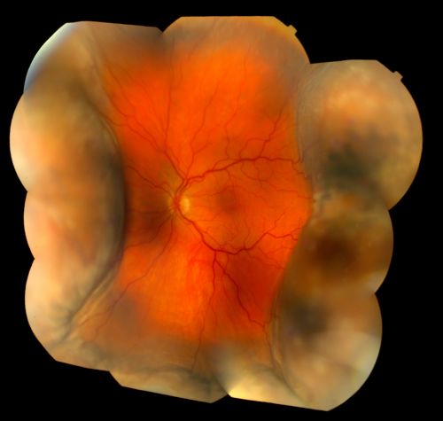 Serous Choroidal Effusions
Serous choroidal effusions following anterior segment surgery. Final visual outcome was 20/20. 
Keywords: Detachment;Serous;Choroidal;Montage;mar2012