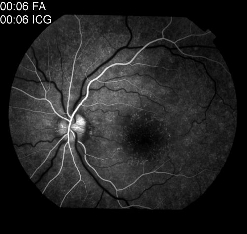 MEWDS
Multiple evanescent white dot syndrome (MEWDS) with classic "wreath pattern" and early optic nerve hyper fluorescence during the arterial phase of the fluorescein angiogram. 
Keywords: MEWDS;White Dot;FA;Fluorescein;Transit