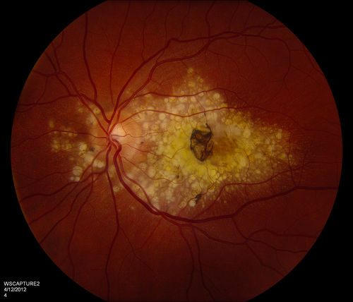 Malattia leventinese
Basal laminar drusen in a perifoveal radial distribution are noted in this rare condition.  Inheritance is AD with variable expressivity but full penetrance. 
Keywords: september2012