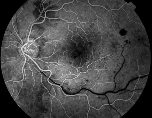 Classic BRVO
Classic branch retinal vein occlusion
Keywords: branch retinal vein occlusion;BRVO;hemorrhage