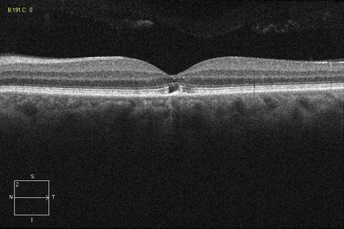 Solar Retinopathy
Foveal defect due to sun staring
Keywords: Solar retinopathy, foveal defect