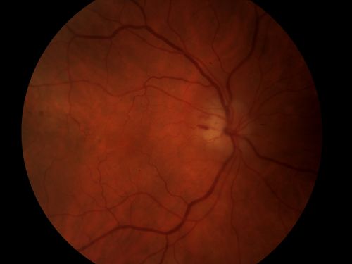 AION Color
Keywords: Acute, Ischemic, Optic Neuropathy, AION