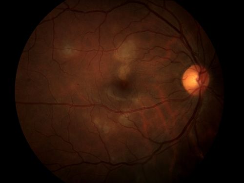 Acute Multifocal Placoid Pigment Epitheliopathy
Keywords: AMPPE, Multifocal, Placoid, Pigment, Epitheliopathy, june2013