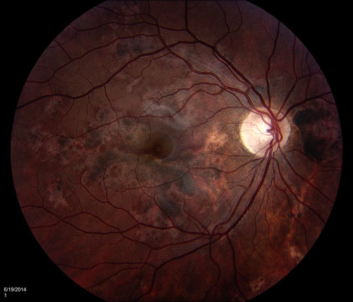 Acute Multifocal Placoid Pigment Epitheliopathy (AMPPE) related scarring
Keywords: Acute;Multifocal;Placoid;Pigment;Epitheliopathy;September;september2014