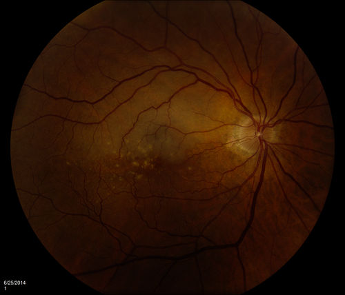 Branch Retinal Artery Occlusion with Hollenhorst Plaque
This patient was found to have retinal edema along the superotemporal arcade secondary to Branch Retinal Artery Occlusion. A Hollenhorst plaque is visible at the first bifurcation of central artery.
Keywords: Artery;occlusion;January;2015;Hollenhorst;plaque;edema;superior