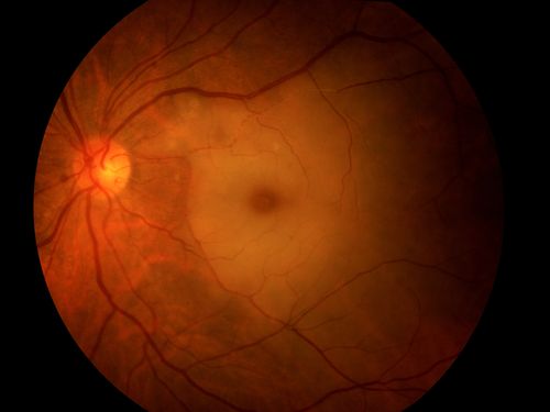 Cilio-Retinal Artery Occlusion with "Box Carring" and Cherry Red Spot
Cilioretinal Artery Occlusion with Cherry Red Spot
Keywords: Branch, Retinal, Artery, Occlusion, Box Carring, Cherry, Red Spot,december2012