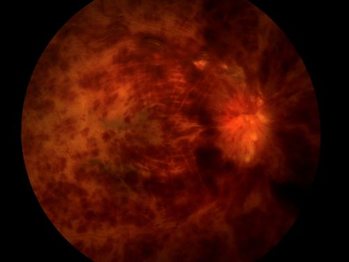 Central Retinal Vein Occlusion
Central Retinal Vein Occlusion
Keywords: Central, Retinal, Venous, Vein, Occlusion