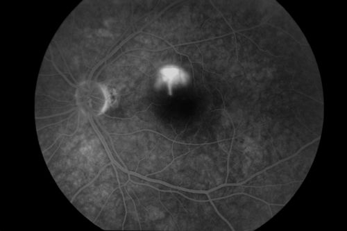 Central Serous Choroidopathy with Smoke Stack and Mushroom Cloud - Fluorescein Angiogram
Keywords: Central, Serous, Choroidopathy, Retinopathy, Smoke Stack, Mushroom, Cloud, Fluorescein, Angiogram, Angiography,april2013