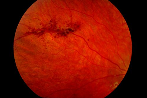 Cavernous Hemangioma
Keywords: cavernous, hemangioma,january2013
