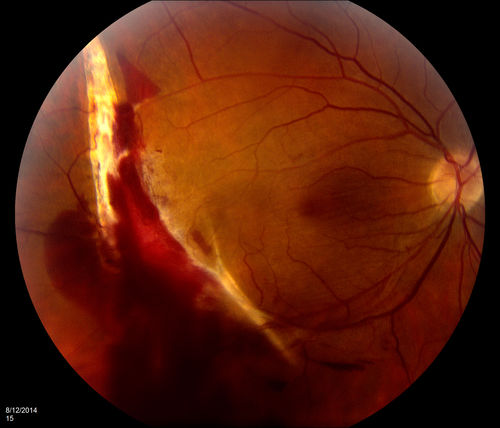 Choriodal Rupture with Hemorrhage
Keywords: August;Choroidal;Rupture;hemorrhage;trauma;fist;punched;august2014