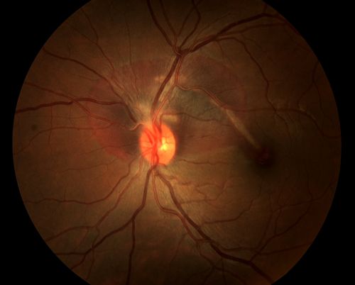 Choroidal Rupture Secondary to Ocular Trauma
Keywords: Choroidal, Rupture, Ocular, Trauma,april2013