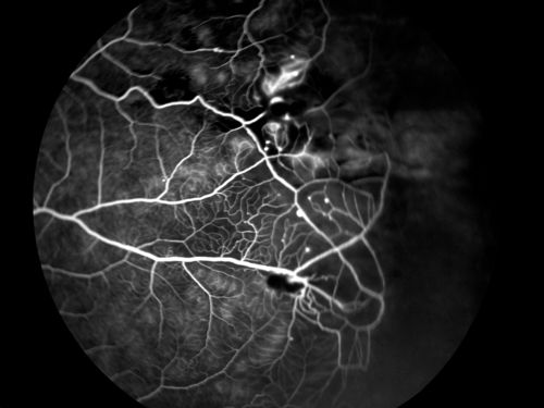 Eales Disease - Fluorescein Angiogram
Keywords: Eales, Disease, Fluorescein, Angiogram, Angiography,april2013