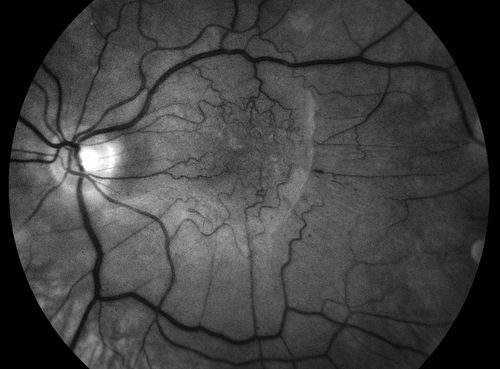 Epiretinal Membrane
Epiretinal Membrane
Keywords: ERM, Epiretinal Membrane, Wrinkling, Retinopathy, Cellophane;august2012