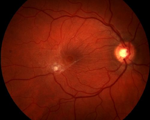 Epiretinal Membrane with Pseudohole
Keywords: Epiretinal, Cellophane, Retinopathy, Wrinkling, Macular, Pucker, Pseudohole,august2013