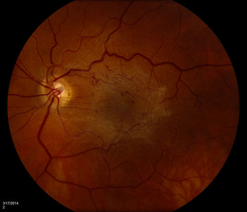 Epiretinal Membrane with Flecks of Hemorrhage
Keywords: april2014
