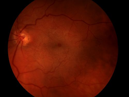 ERM with Pseudohole
Keywords: ERM;Epiretinal membrane;pseudohole;wrinkling retinopathy;cellophane retinopathy;december2013