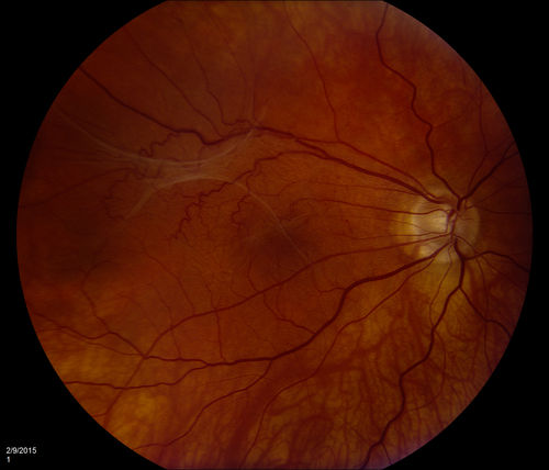 ERM
ERM: Epiretinal Membrane	
Five years prior to presentation this patient was struck in the eye with a basketball, suffering a vitreal hemorrhage.  He underwent vitrectomy and cataract surgery.  He later developed a faint ERM.   On recent presentation he complained of increased blurring and a floater in his O.D. Examination determined that the ERM had become more prominent.

Mots-clés: ERM;epiretinal;membrane;wrinkling;cellophane;retinopathy;retinal;macular pucker