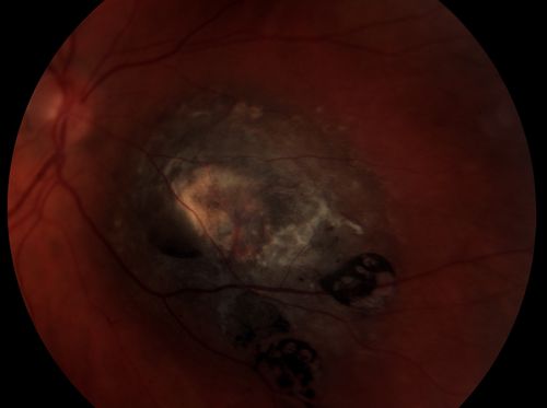 Elevated Nevus
Keywords: Nevus, Elevated,october2013