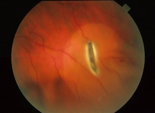 Intraocular Foreign Body
Intraocular Foreign Body
Keywords: Foreign Body, Intraocular