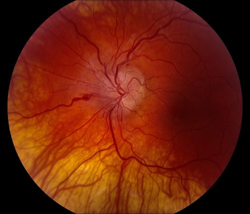 Idiopathic Intracranial Hypertension O.S.
Mots-clés: Intra;Cranial;hypertension;March 2014