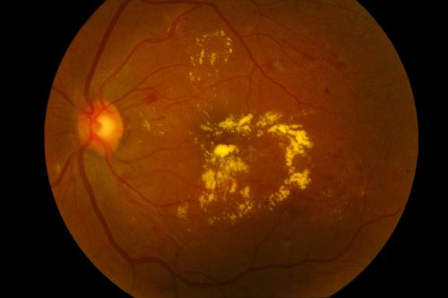 Nonprolific Diabetic Retinopathy with Circinate Ring
Nonprolific Diabetic Retinopathy with Circinate Ring
Keywords: Nonproliferative, Diabetic, Retinopathy, Hard Exudates, Exudates, Circinate, Ring