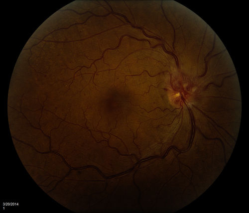 Papilledema
Keywords: Disc;edema;papillary;papilla edema;engorgment;May 2014