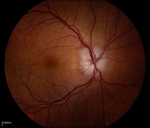 Papilledema
Keywords: Optic;nerve;disc;edema;papilledema;swollen;September