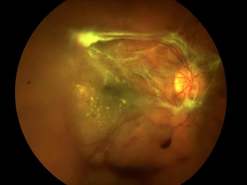 Proliferative Diabetic Retinopathy with Tractional Retinal Detachment
Proliferative Diabetic Retinopathy with Tractional Retinal Detachment
Keywords: Proliferative, Diabetic, Retinopathy, Detachment, Retinal, Traction, Tractional
