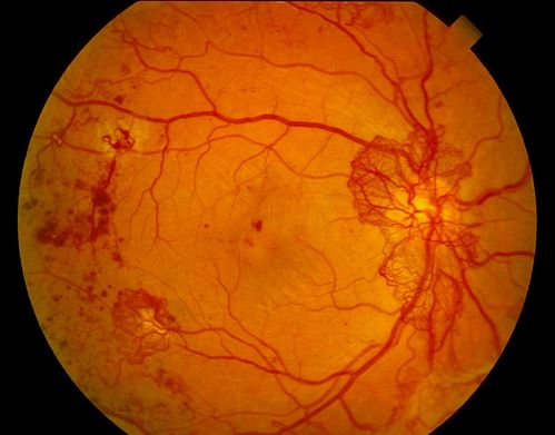 Juvenile Onset Diabetic - Proliferative Diabetic retinopathy with NVE and NVD
Proliferative Diabetic Retinopathy with Neovascularization of the Disc and Neovascularization Elsewhere.
James L. Perron, C.R.A.
Keywords: Juvenile, Diabetic, Proliferative, Retinopathy, NVE, NVD, Neovascularization, Disc, Elsewhere;july2012