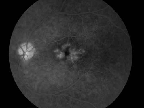 Pseudophakic Cystoid Macular Edema FA late frame
Keywords: Pseudophakic, Cystoid, Macular, Edema,august2013