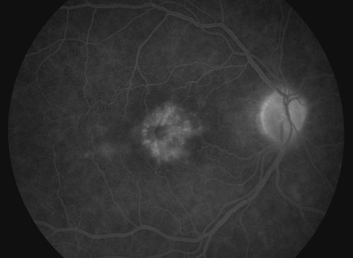 Pseudophakic Cystoid Macular Edema with Disc Hyperfluorescence
Keywords: december2013