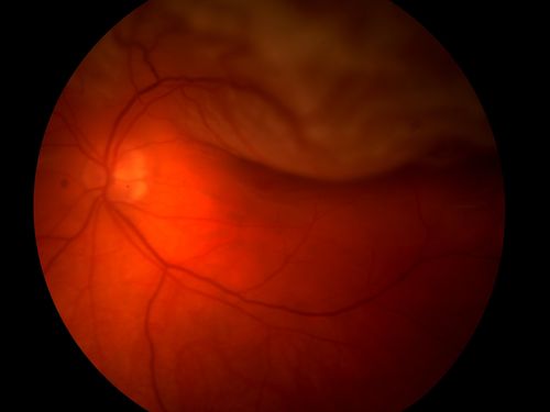 Retinal Detachment
Schlüsselwörter: retinal, detachment, Macula-off