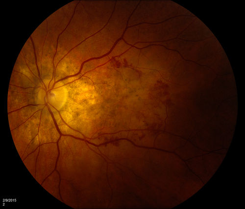 ARMD:  Macular Degeneration with Subretinal Neovascular Membrane
ARMD:  Macular Degeneration with Subretinal Neovascular Membrane. 
Upon presentation, this patient was found to have blots of subretinal hemorrhage extending into her FAZ, secondary to a subretinal neovascular membrane. 

Keywords: ARMD;Subretinal;neovascular;neovascularization;membrane;February
