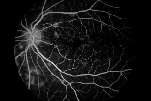 Stargardt's Dystrophy - Silent Choroid - Fluorscein Angiogram
Keywords: september2013