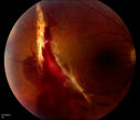 Choroidal_Rupture_with_Hemorrhage_.JPG
