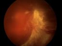 Diabetic_Tractional_Retinal_Detachment.jpg