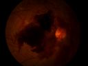 Proliferative_Diabetic_Retinopathy_with_NVD2C_NVE_and_Pre_Retinal_Heme.JPG