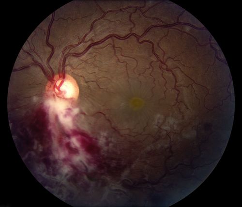 Cytomeglovirus
25 year old male experiencing blurry vision OS for two days.  Onset very rapid.  VA 20/40 OS 20/30 OD.  After HIV titer test, determined the pt. had HIV and Cytomeglovirus.
Keywords: cytomeglovirus, brvo, hiv,april2012