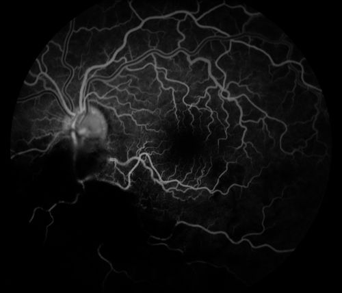 Cytomeglovirus
25 year old male experiencing blurry vision OS for two days.  Onset very rapid.  VA 20/40 OS 20/30 OD.  After HIV titer test, determined the pt. had HIV and Cytomeglovirus.
Palabras clave: cytomeglovirus, brvo, hiv