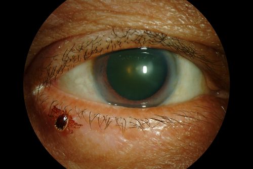 Tick on Lower Lid
Pt. came in for cataract surgery and a tick was found on the lower lid.  Pt. had no idea the tick was attached and did not know how long it had been there.  Tick was photographed and then removed by physician.
Keywords: External, Slit Lamp