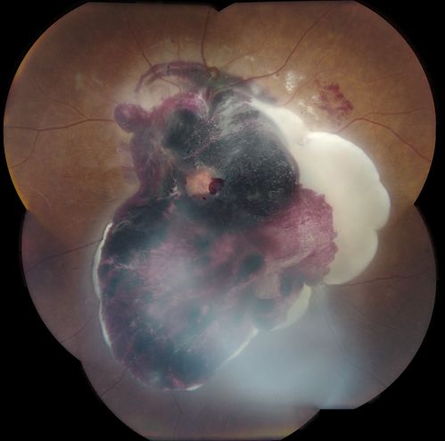 Severe Hemorrhage from NVD and NVE Due To PDR
60 year old female with Diabetic Retinopathy.  VA 20/40 OD HM OS.  History of Dot and Blot hemorrhages and cotton-wool spots associated with Diabetes.  Severe Hemorrhaging due to NVD and NVE.  Pt stated sight decreased very rapidly.
Keywords: diabetic, retinopathy, hemorrhage, blood, cotton-wool, PDR, IDDM