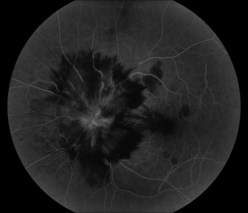 CRVO
58 year old male with present CRVO OU.  Visual Acuity 20/30 OD 20/200 OS.  Pt. recently underwent surgery for cancer of the bladder and has other blood and hemoglobin issues.  Pt sent for further blood work and see a neurologist.  
Keywords: CRVO, hemorrhage