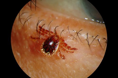 Tick on Lower Lid
Pt. came in for cataract surgery and a tick was found on the lower lid.  Pt. had no idea the tick was attached and did not know how long it had been there.  Tick was photographed and then removed by physician.
Keywords: External, Slit Lamp