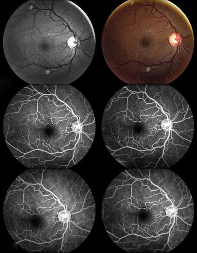 Cytomeglovirus
25 year old male experiencing blurry vision OS for two days.  Onset very rapid.  VA 20/40 OS 20/30 OD.  After HIV titer test, determined the pt. had HIV and Cytomeglovirus.
Keywords: cytomeglovirus, brvo, hiv
