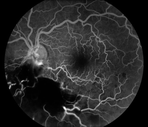 Cytomeglovirus
25 year old male experiencing blurry vision OS for two days.  Onset very rapid.  VA 20/40 OS 20/30 OD.  After HIV titer test, determined the pt. had HIV and Cytomeglovirus.
Keywords: cytomeglovirus, brvo, hiv