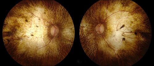 Chorodial Sclerosis
74 year old female diagnosed with Chorodial Sclerosis OU and ARMD OU.  Va 20/400 OD 2'200 OS
Keywords: wet amd, choroid, sclerosis, chorodial