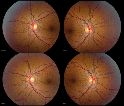 PXE with Angioid Streaks (4-up for comparison)
PXE with angioid streaks OU, 4-up for comparison between 2010 and 2011 - angioid streaks are stable.
Keywords: Angioid;Streaks