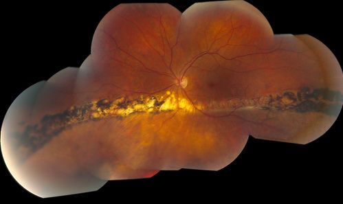 Chronic Retinal Detachment
51 year old female, with a chronic retinal detachment.  The patient has been stable since 1999.
Keywords: retinal;detachment;april2012